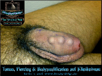 Beading-Implantat-Intim-Penis-Piercing-Bodymod-by-Bodyship-Halle---Sachsen-Anhalt---www.bodyship.de Beading-Implantat-Intim-Penis-Piercing-Bodymod-by-Bodyship-Halle---Sachsen-Anhalt---www.bodyship.de