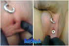 Transcrotal Tunnel Hoden Schneiden Punchen vernähen durchführen-Intim-Piercing--Bodymod-by-Ben-Bodyship-Halle---www_bodyship_de---Sachsen-Anhalt1