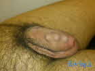 db_Beading-Penis-Silikon-Kugel-Implantat-gemacht-im-Bodyship_de-Tattoo--Piercing---Bodymodification-Studio-Halle1