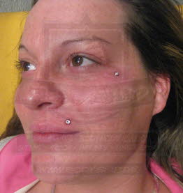 Microdermal am Auge und der Oberlippe by BodyShip Halle