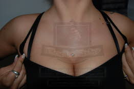 Microdermal im Dekolette by BodyShip Halle